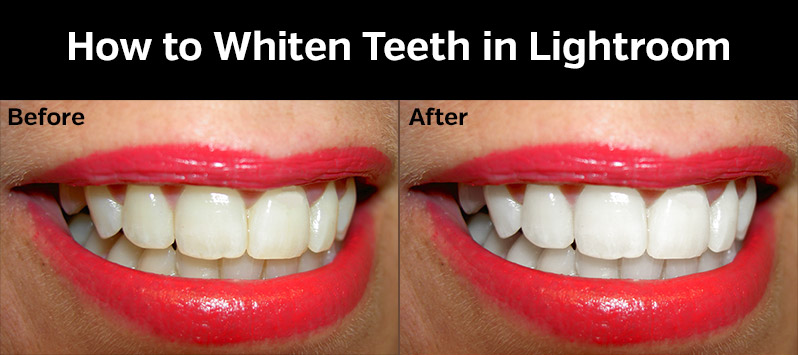 lighten teeth